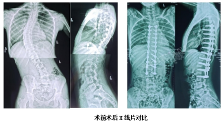 关于三个月婴儿脊柱侧弯的症状研究