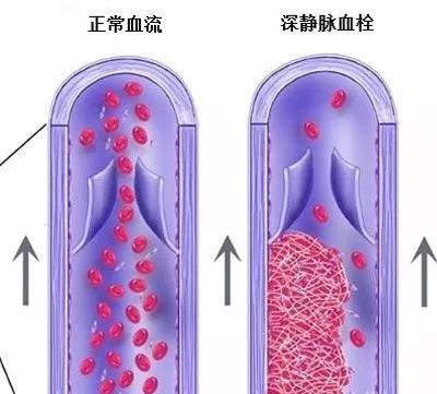 吃激素两个月引发骨头坏死的警示